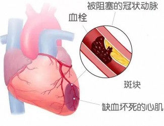 血栓的形成原因及后果，如何預(yù)防血栓導(dǎo)致的疾病