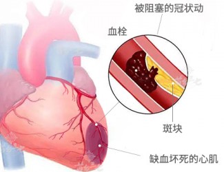 心臟病該怎么辦，且看臨床治療醫(yī)案一則